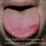 oral-signs-and-symptoms-of-iron-deficiency-anemia